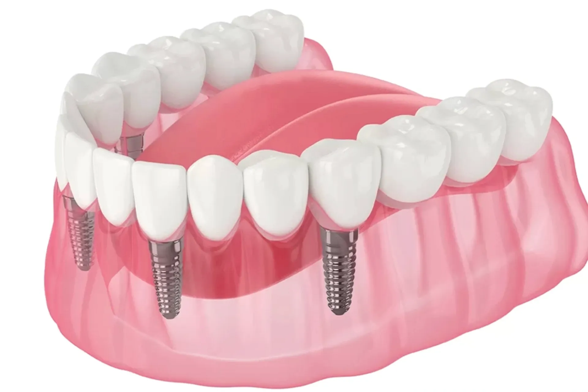 All on 4 Implants