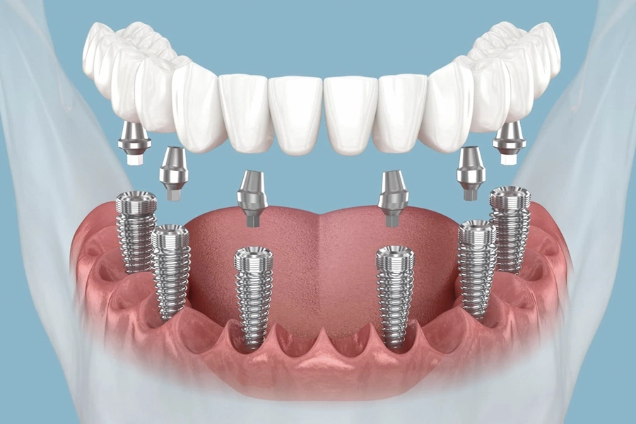 All on six dental implants in Antalya