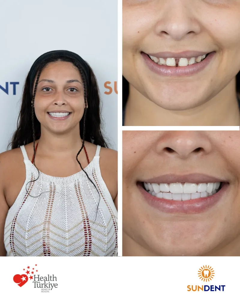 Before & After Treatment 1 — Sundent Dental Clinic