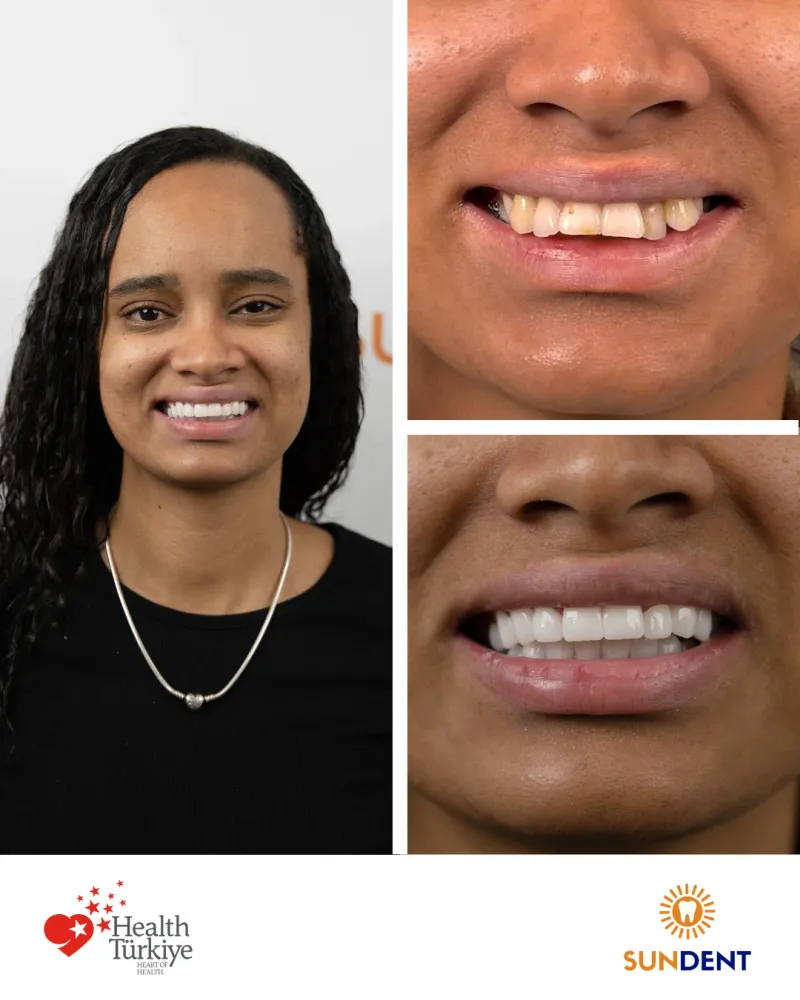 Before & After Treatment 10 — Sundent Dental Clinic