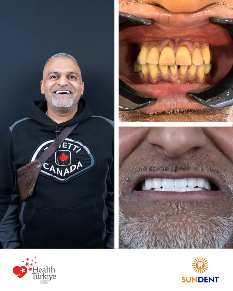 Before & After Treatment 11 — Sundent Dental Clinic
