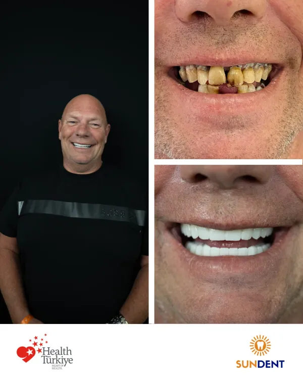 Before and After Treatment 12