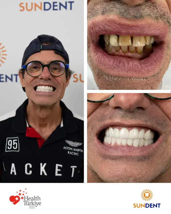 Before and After Treatment 13