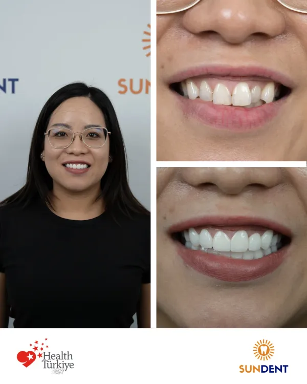 Before and After Treatment 14