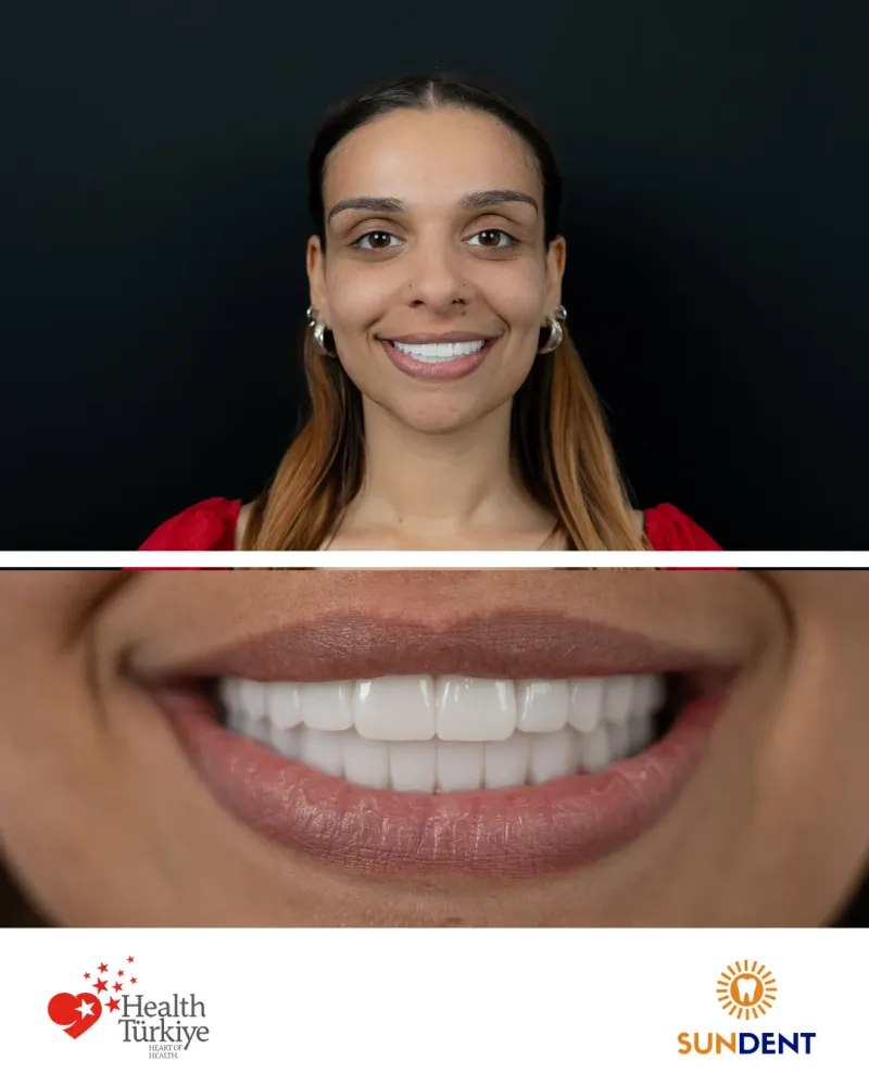 Before & After Treatment 15 — Sundent Dental Clinic
