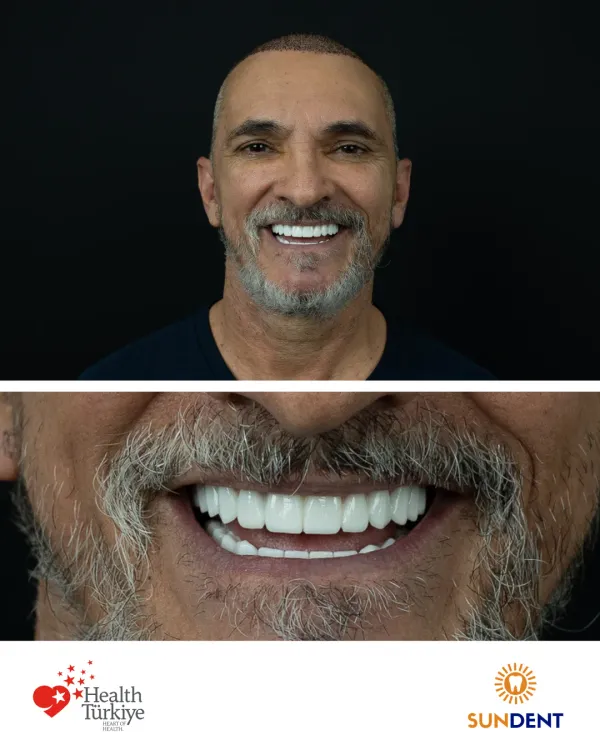 Before and After Treatment 17