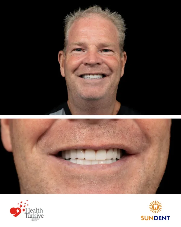 Before and After Treatment 19