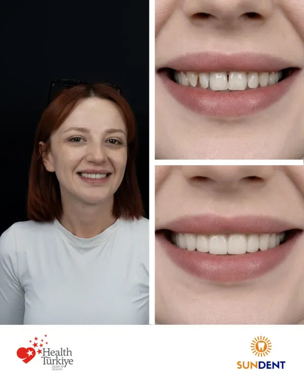 Before and After Treatment 2