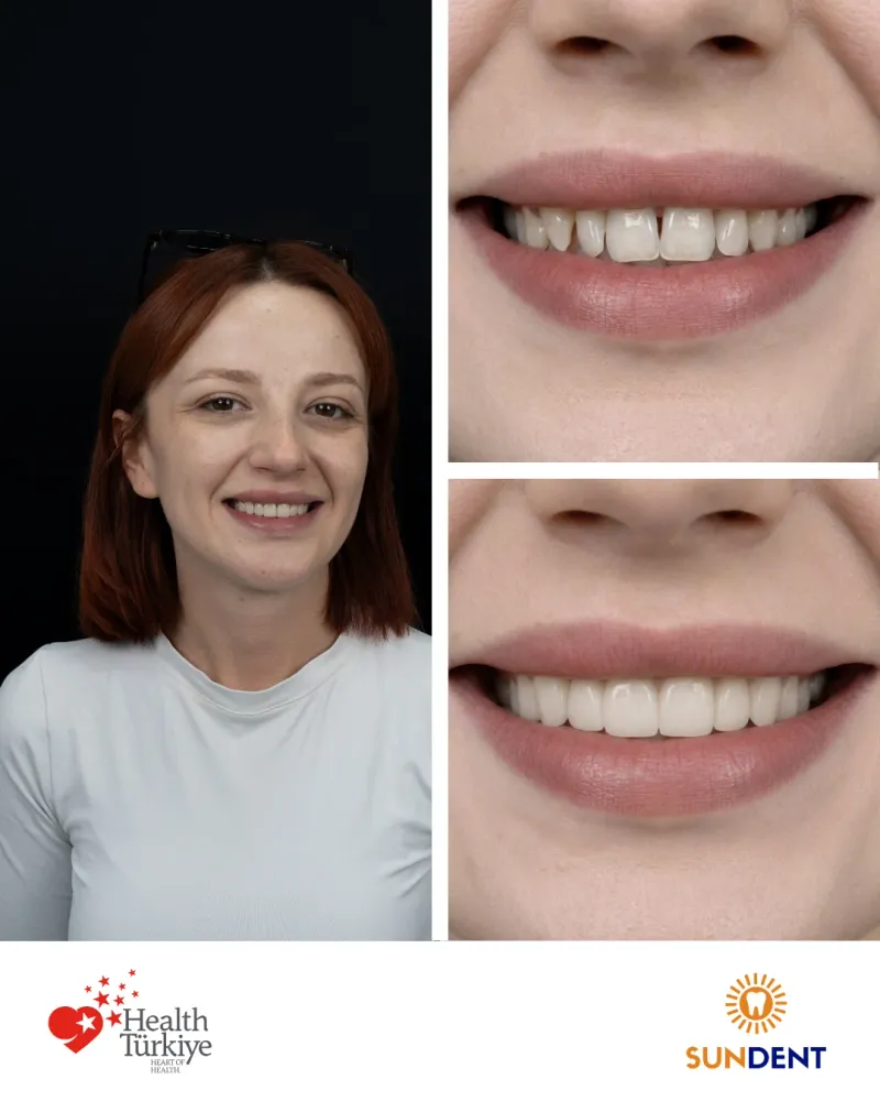 Before & After Treatment 2 — Sundent Dental Clinic