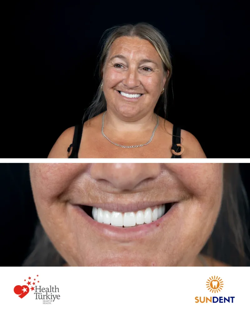 Before & After Treatment 20 — Sundent Dental Clinic