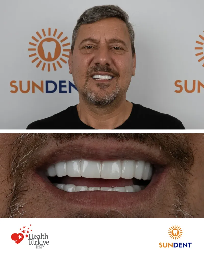 Before & After Treatment 21 — Sundent Dental Clinic