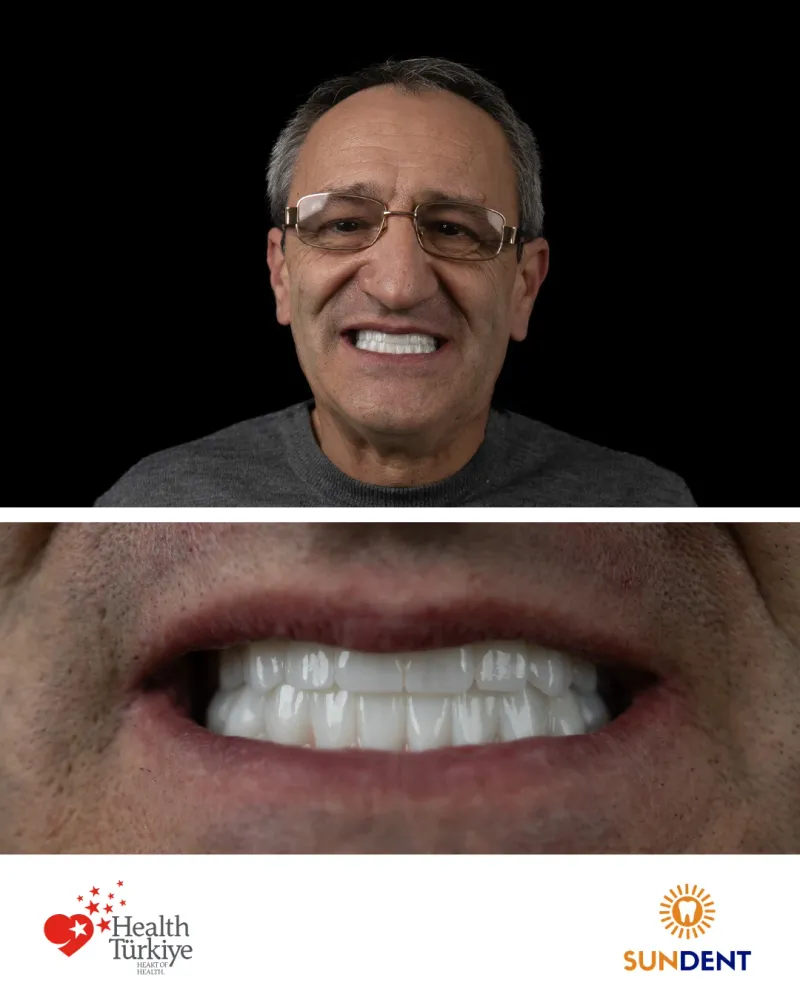 Before & After Treatment 22 — Sundent Dental Clinic