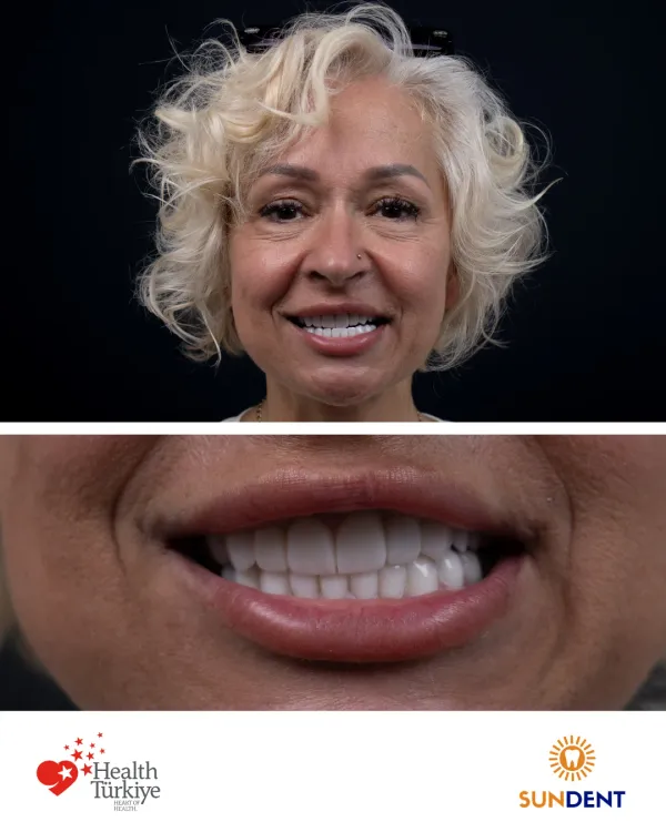 Before and After Treatment 23