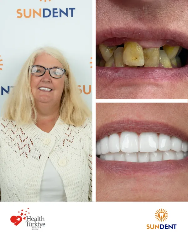 Before and After Treatment 3