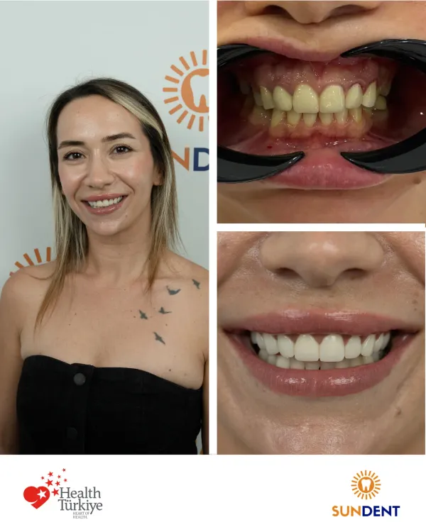 Before and After Treatment 4