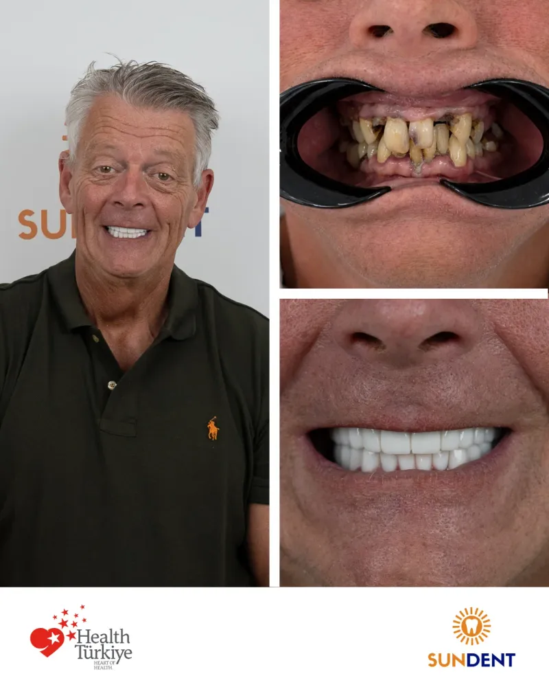 Before & After Treatment 5 — Sundent Dental Clinic