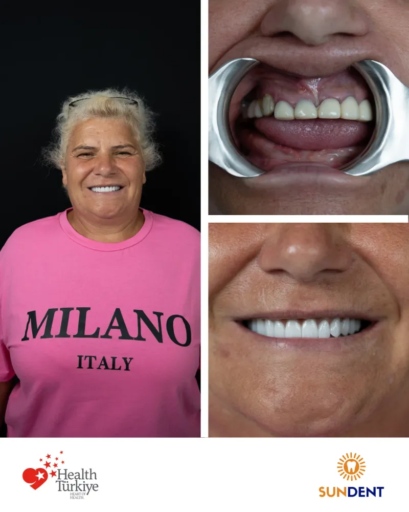 Before & After Treatment 6 — Sundent Dental Clinic