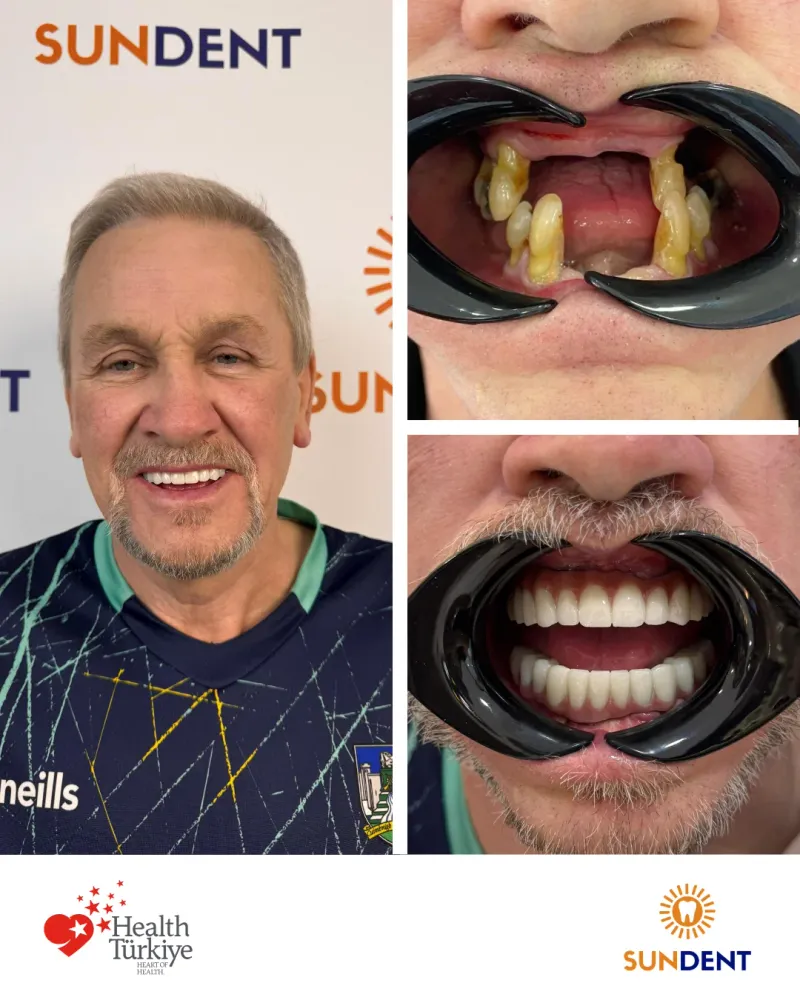 Before & After Treatment 8 — Sundent Dental Clinic