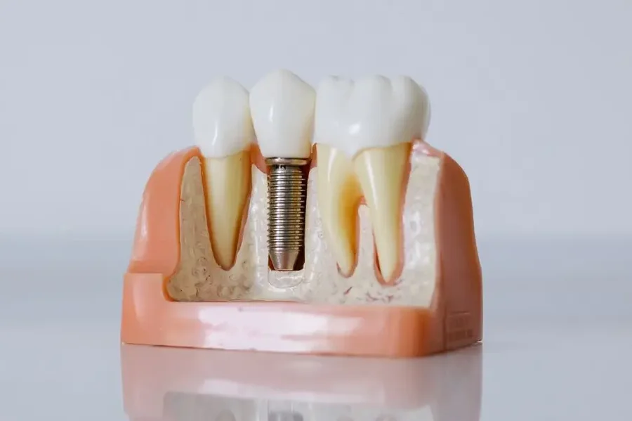 Dental implant procedure at Sundent Dental Clinic in Antalya