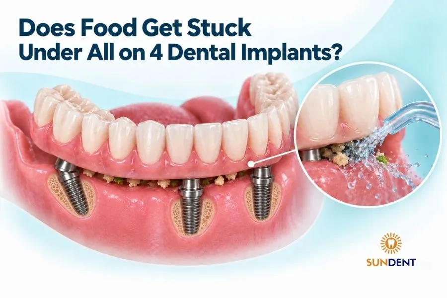 Does food get stuck under All on 4 dental implants? Antalya